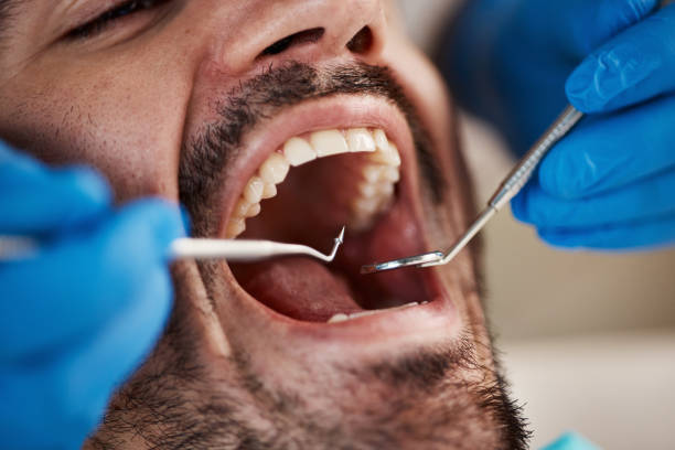 Best Emergency Gum Treatment in Kentfield, CA